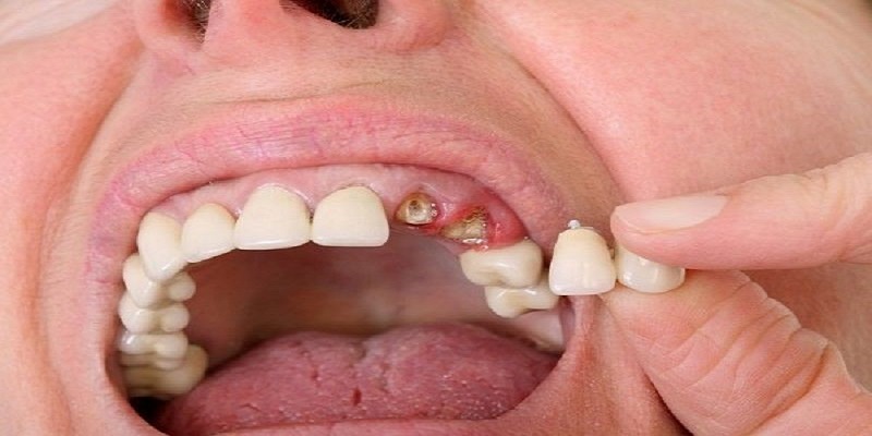 Rụng răng hàm trên có điềm báo gì?